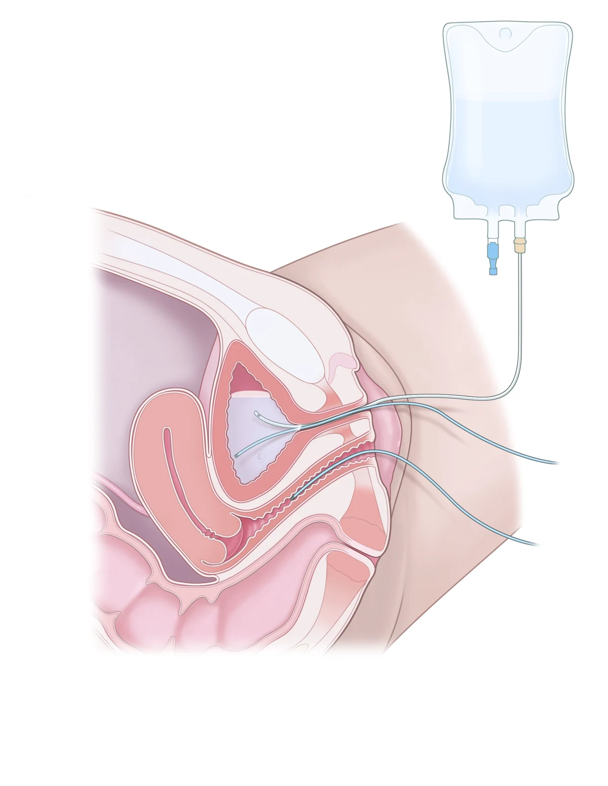 Cystometry illustration showing catheters and a fluid bag used to assess bladder pressure